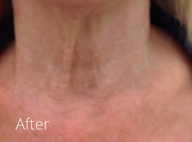 Hadleigh Cosmetic fillers