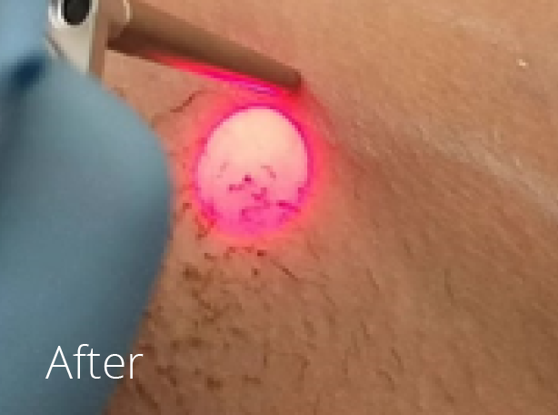 Hadleigh Hair laser near me