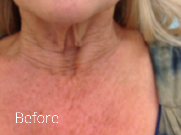 Juvederm fillers Woodbridge