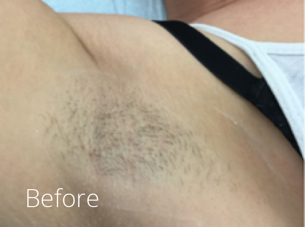 Laser hair removal for men Colchester