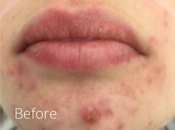 Rosacea therapy Woodbridge