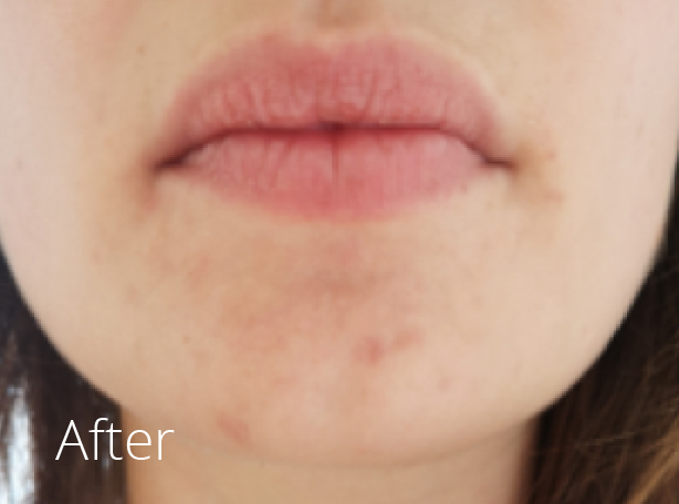 Felixstowe Rosacea therapy