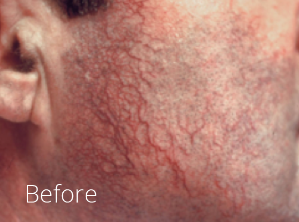 Telangiectasia Ipswich