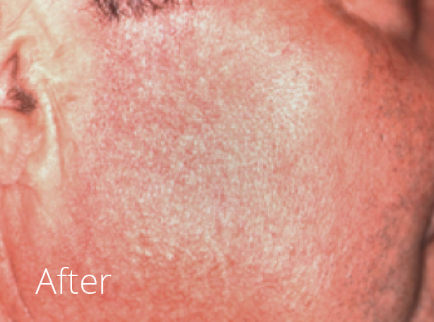 Hadleigh Telangiectasia